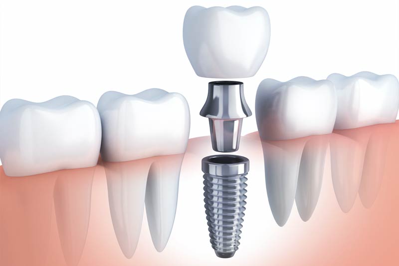 Implants Dentist in Renton