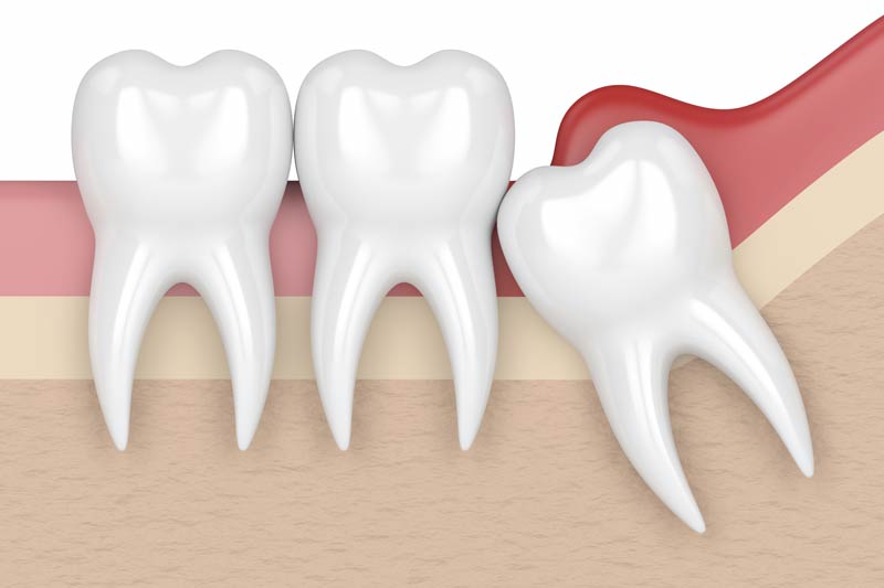 Wisdom Tooth Removal in Renton